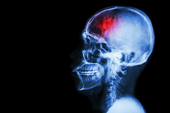 A X-Ray example of a concussion.